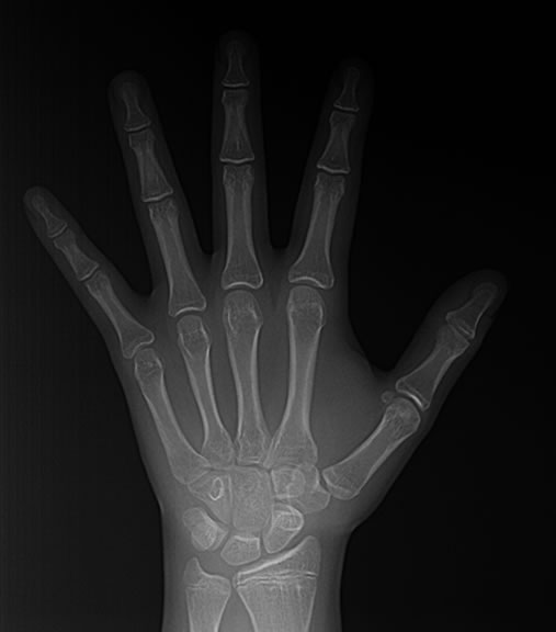 Radiografia de Mão e Punho